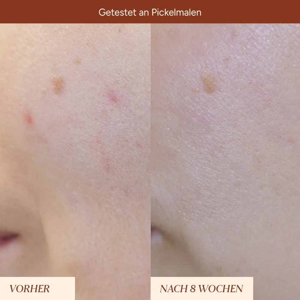 JUNGLÜCK Pigmentflecken Roll-On Serum 5 ml Arbutin