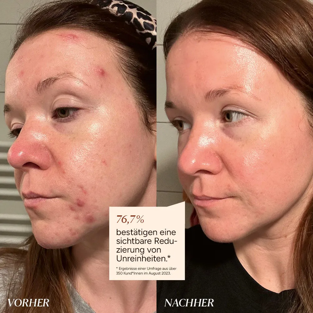 JUNGLÜCK Unreinheiten mindern Set Azelainsäure Aloe
