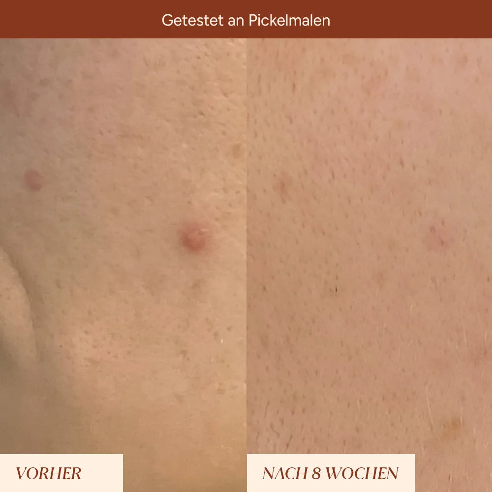 JUNGLÜCK Pigmentflecken Roll-On Serum 5 ml Arbutin